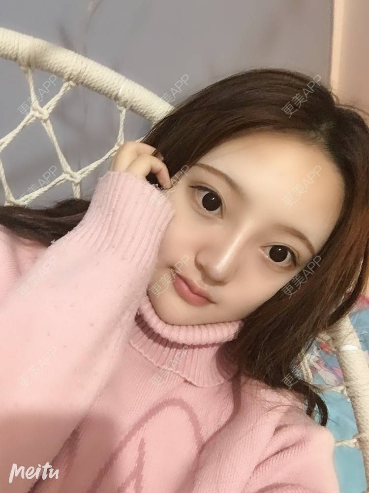 更美 - 更美用户ZSYAfLAIcp的硅胶隆鼻经验 | 硅胶隆鼻 | 长春 | 耳软骨隆鼻