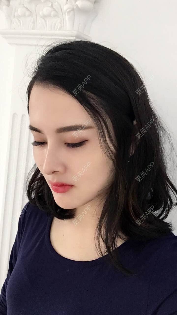 更美用户m6g8xtocgh的玻尿酸隆鼻日记