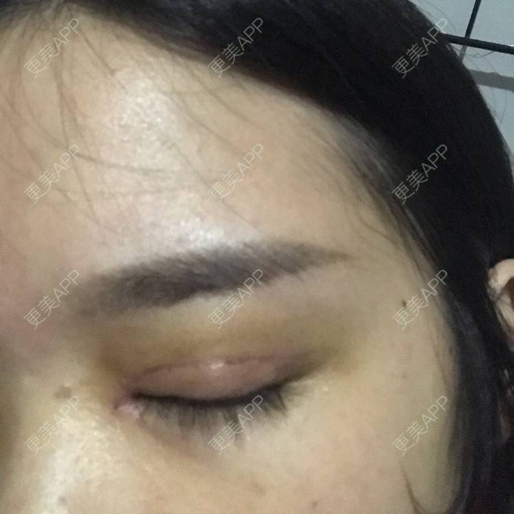 更美 - 更美用户pw2FXbUb8o的全切双眼皮经验 | 全切双眼皮 | 开内眼角 | 贵阳 | 眼部多项