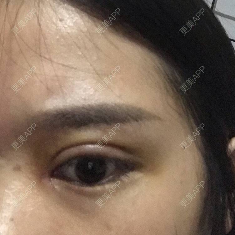 更美 - 更美用户pw2FXbUb8o的全切双眼皮经验 | 全切双眼皮 | 开内眼角 | 贵阳 | 眼部多项