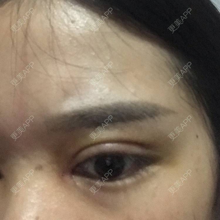 更美 - 更美用户pw2FXbUb8o的全切双眼皮经验 | 全切双眼皮 | 开内眼角 | 贵阳 | 眼部多项