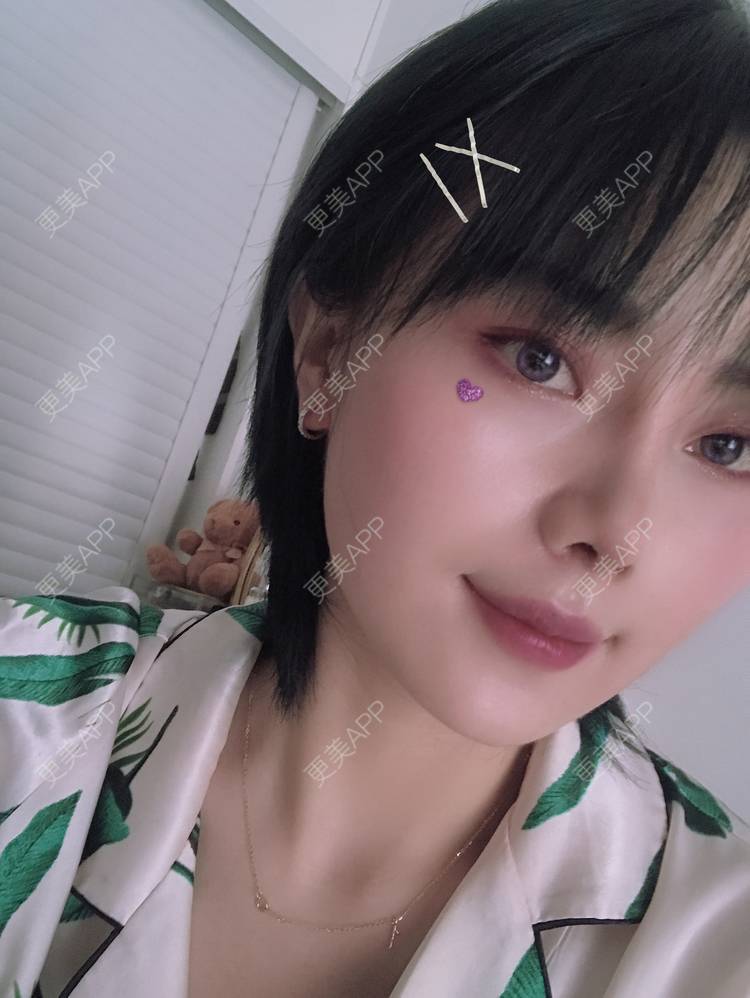 更美 - 更美用户R8DRI4045X的鼻部多项经验 | 成都 | 鼻部多项