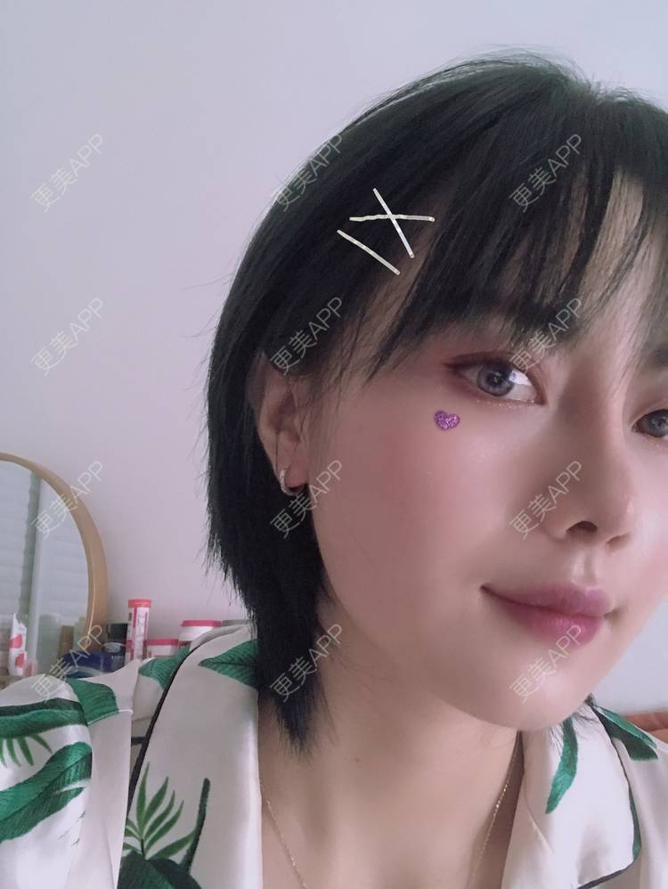 更美 - 更美用户R8DRI4045X的鼻部多项经验 | 成都 | 鼻部多项