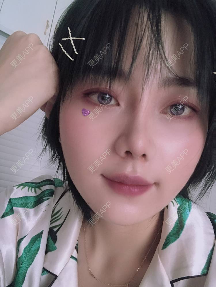更美 - 更美用户R8DRI4045X的鼻部多项经验 | 成都 | 鼻部多项