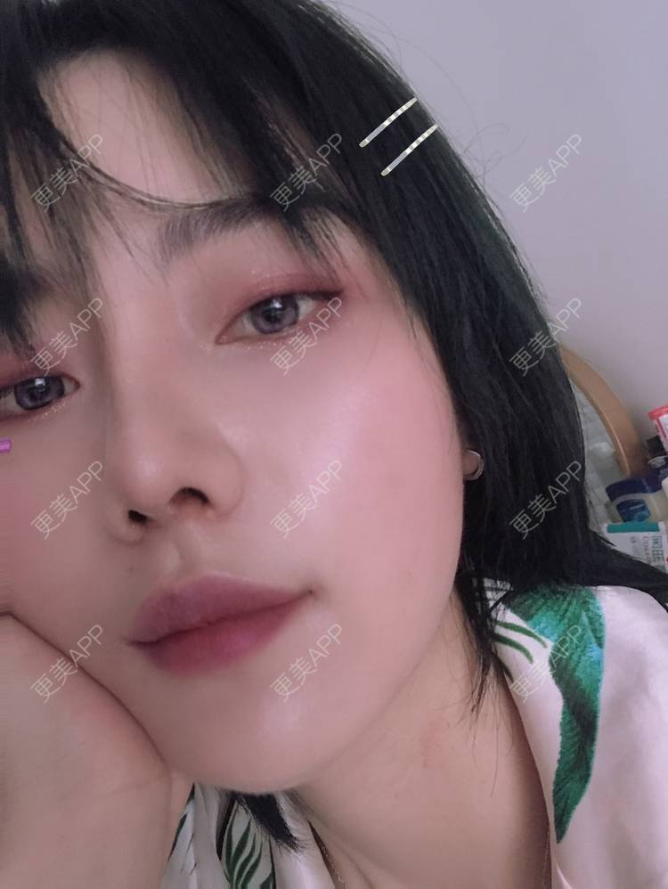 更美 - 更美用户R8DRI4045X的鼻部多项经验 | 成都 | 鼻部多项