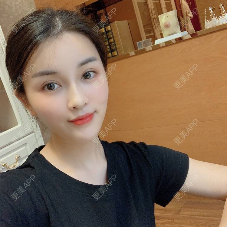 更美 - 沫沫mo😍的玻尿酸面颊经验 | 杭州 | 玻尿酸面颊