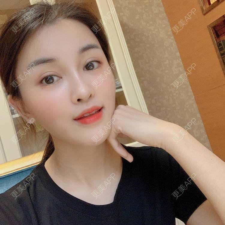 更美 - 沫沫mo😍的玻尿酸面颊经验 | 杭州 | 玻尿酸面颊