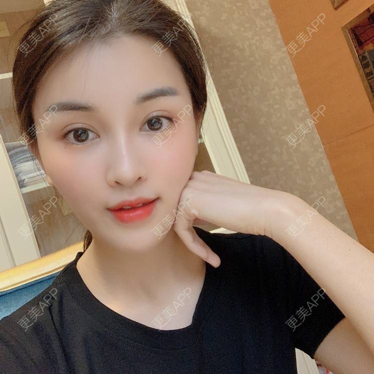 更美 - 沫沫mo😍的玻尿酸面颊经验 | 杭州 | 玻尿酸面颊