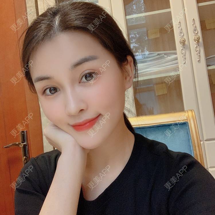 更美 - 沫沫mo😍的玻尿酸面颊经验 | 杭州 | 玻尿酸面颊