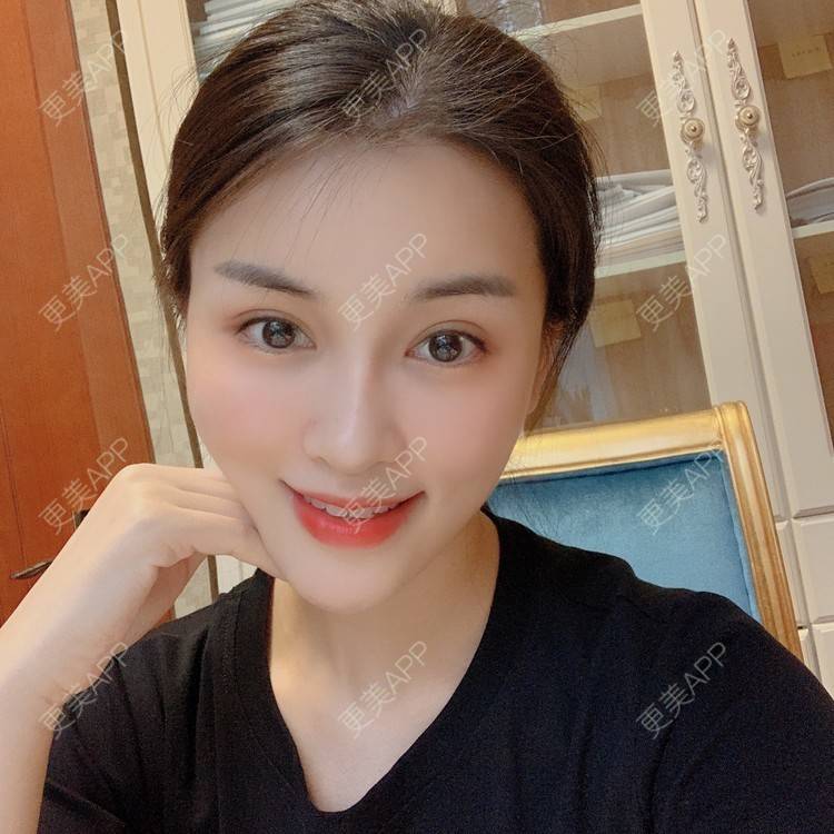 更美 - 沫沫mo😍的玻尿酸面颊经验 | 杭州 | 玻尿酸面颊