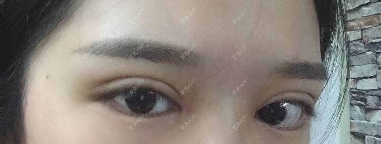 更美 - 更美用户pw2FXbUb8o的全切双眼皮经验 | 全切双眼皮 | 开内眼角 | 贵阳 | 眼部多项