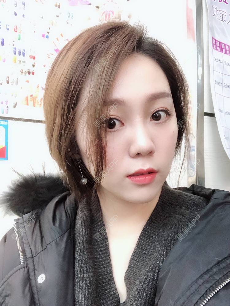 更美 - 更美用户dzhtMneR9R的像素激光经验 | 像素激光 | 红蓝光清痘 | 果酸焕肤
