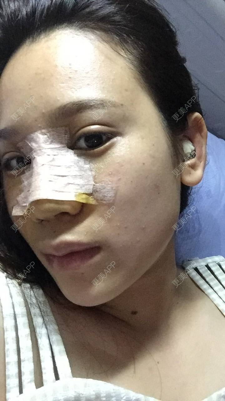 更美 - 更美用户RwtQyrji7u的鼻部多项经验 | 鼻部多项 | 成都