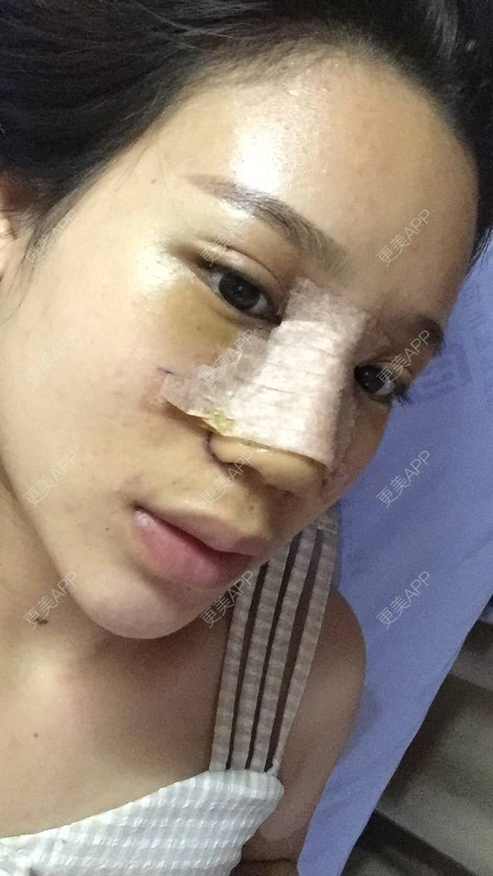 更美 - 更美用户RwtQyrji7u的鼻部多项经验 | 鼻部多项 | 成都