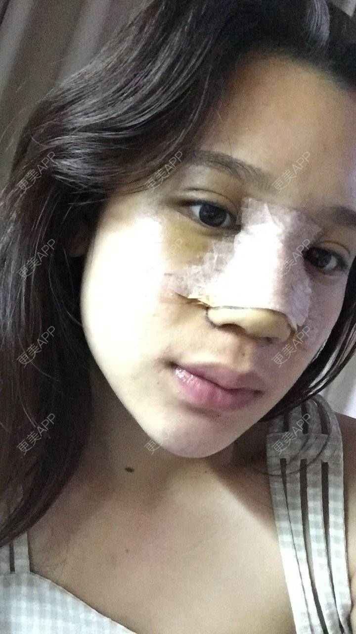 更美 - 更美用户RwtQyrji7u的鼻部多项经验 | 鼻部多项 | 成都