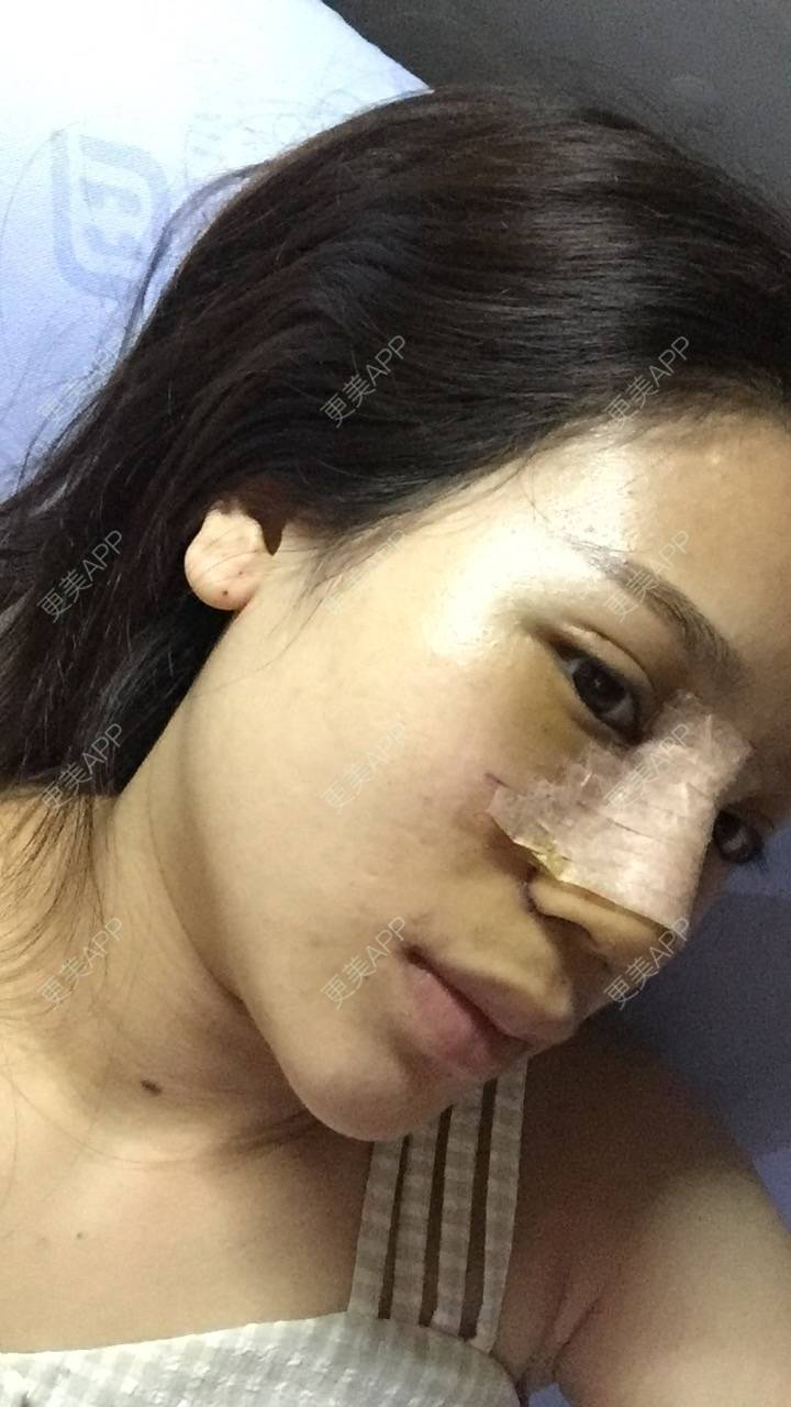 更美 - 更美用户RwtQyrji7u的鼻部多项经验 | 鼻部多项 | 成都