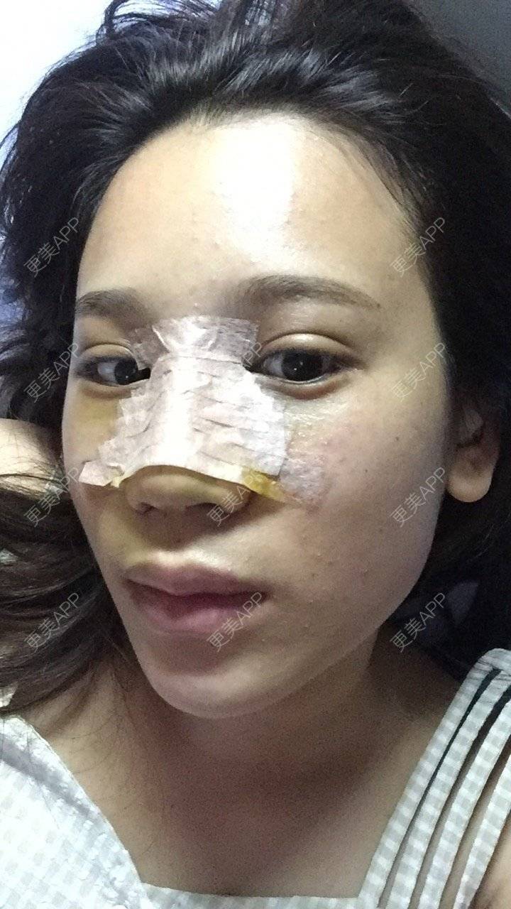 更美 - 更美用户RwtQyrji7u的鼻部多项经验 | 鼻部多项 | 成都