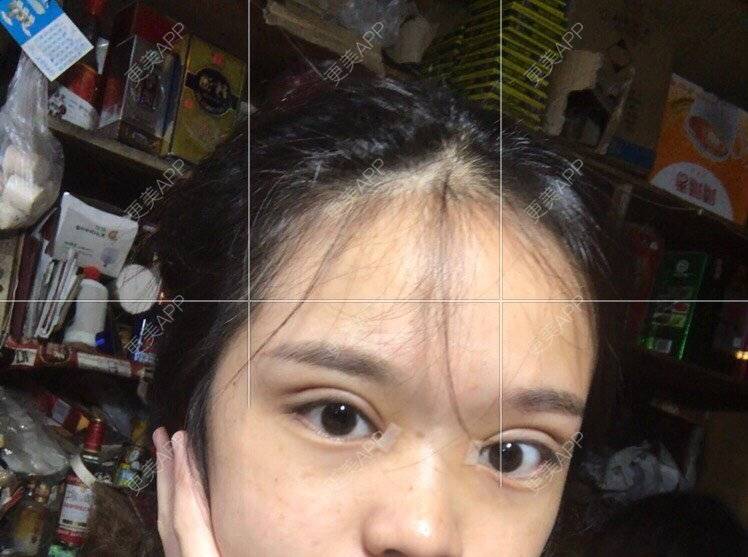 更美 - 更美用户pw2FXbUb8o的全切双眼皮经验 | 全切双眼皮 | 开内眼角 | 贵阳 | 眼部多项