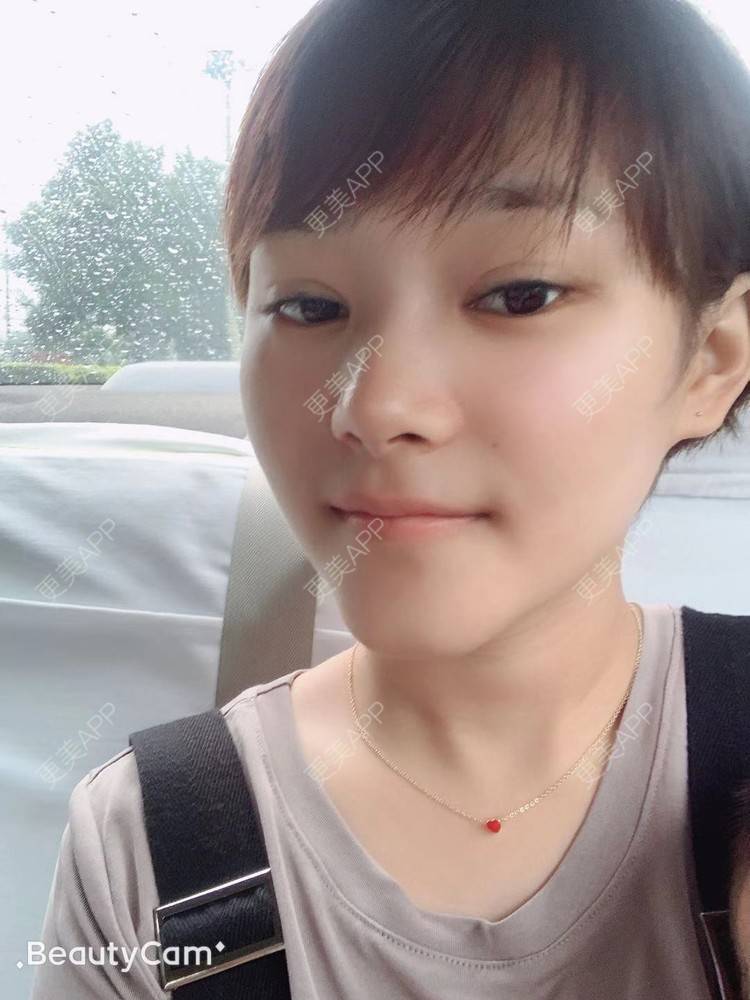 更美 - 白鹿傲娇的玻尿酸颈纹经验 | 玻尿酸颈纹 | 北京