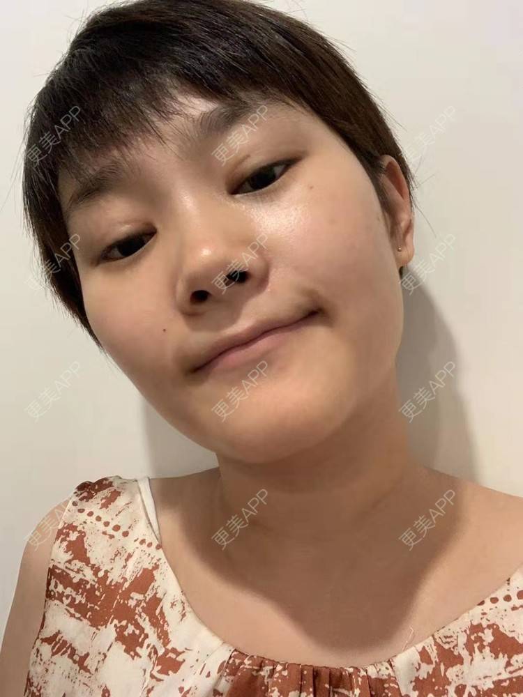 更美 - 白鹿傲娇的玻尿酸颈纹经验 | 玻尿酸颈纹 | 北京