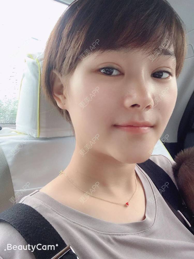 更美 - 白鹿傲娇的玻尿酸颈纹经验 | 玻尿酸颈纹 | 北京