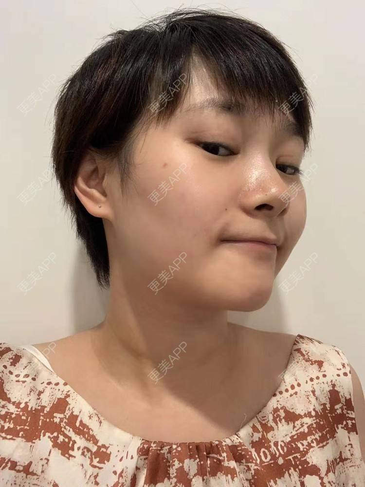 更美 - 白鹿傲娇的玻尿酸颈纹经验 | 玻尿酸颈纹 | 北京