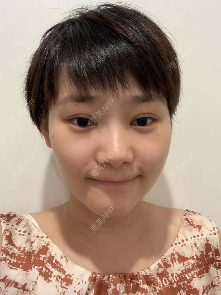 更美 - 白鹿傲娇的玻尿酸颈纹经验 | 玻尿酸颈纹 | 北京