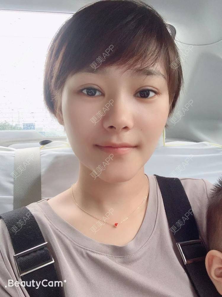 更美 - 白鹿傲娇的玻尿酸颈纹经验 | 玻尿酸颈纹 | 北京