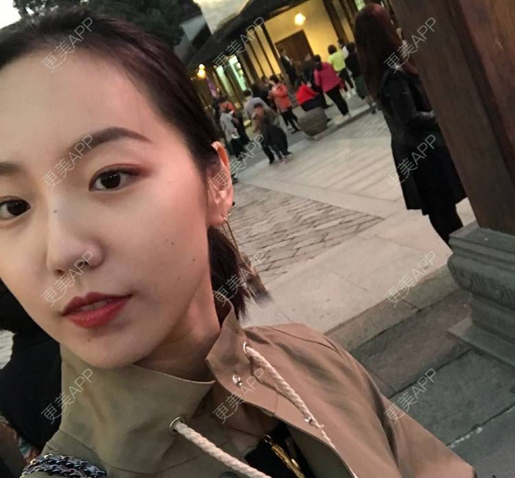 更美 - 扬扬AD的树脂补牙经验 | 树脂补牙