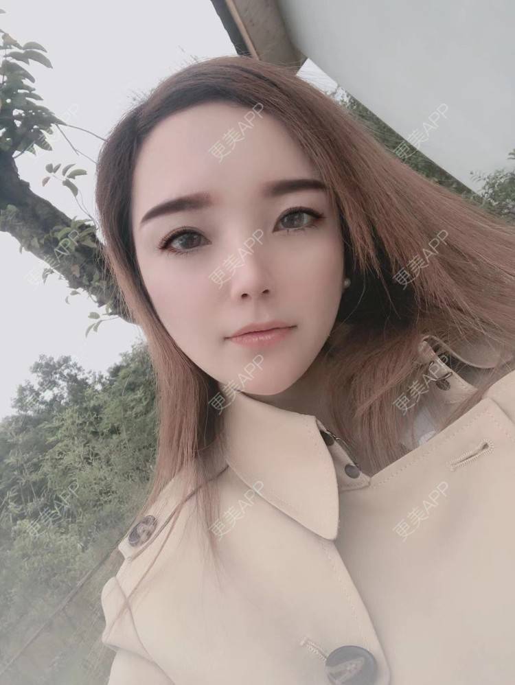 更美 - 更美用户EWqDuvHmIb的自体脂肪丰面颊经验 | 自体脂肪丰面颊 | 成都