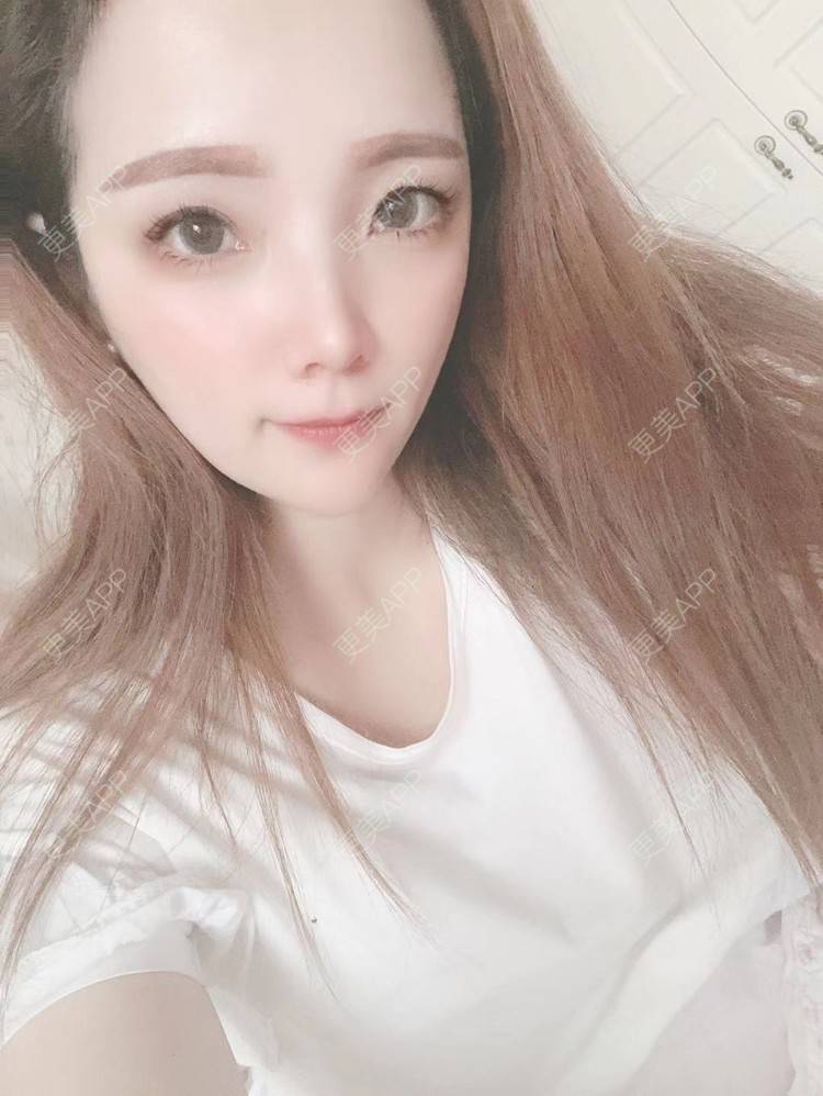 更美 - 更美用户EWqDuvHmIb的自体脂肪丰面颊经验 | 自体脂肪丰面颊 | 成都