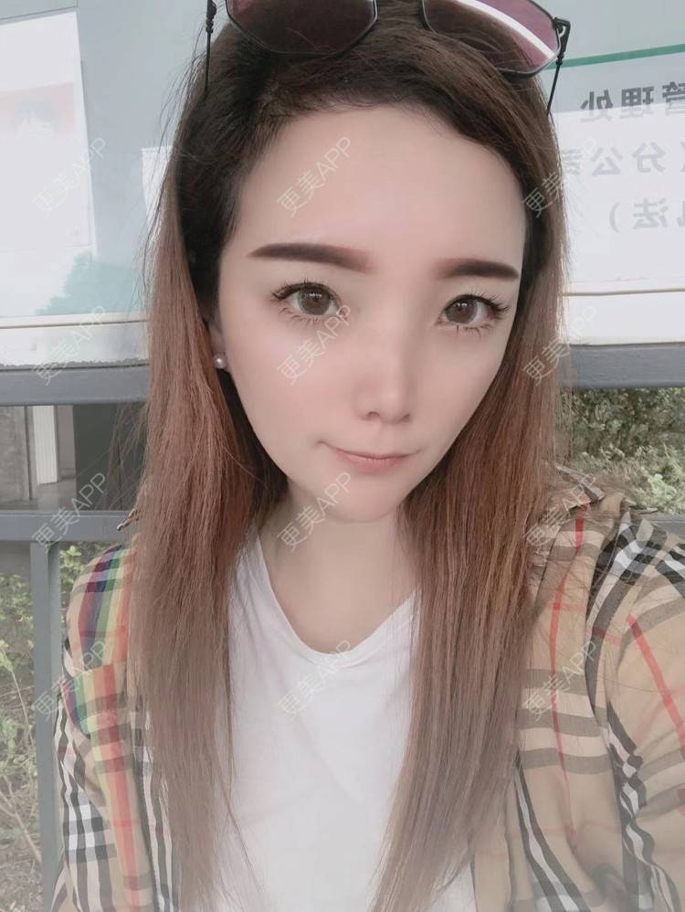更美 - 更美用户EWqDuvHmIb的自体脂肪丰面颊经验 | 自体脂肪丰面颊 | 成都