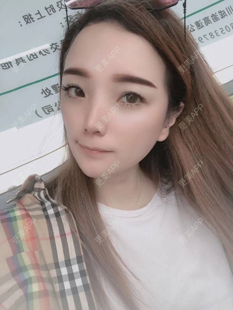 更美 - 更美用户EWqDuvHmIb的自体脂肪丰面颊经验 | 自体脂肪丰面颊 | 成都