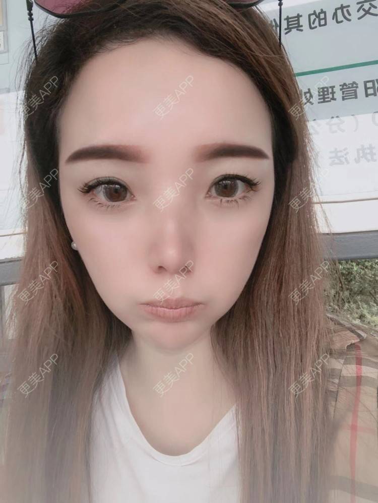 更美 - 更美用户EWqDuvHmIb的自体脂肪丰面颊经验 | 自体脂肪丰面颊 | 成都