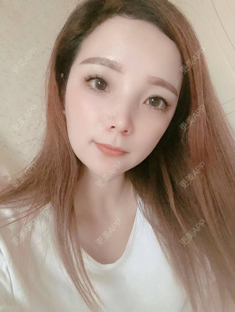 更美 - 更美用户EWqDuvHmIb的自体脂肪丰面颊经验 | 自体脂肪丰面颊 | 成都