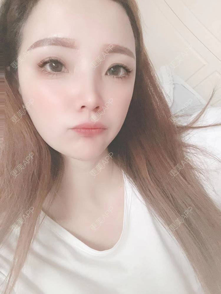 更美 - 更美用户EWqDuvHmIb的自体脂肪丰面颊经验 | 自体脂肪丰面颊 | 成都