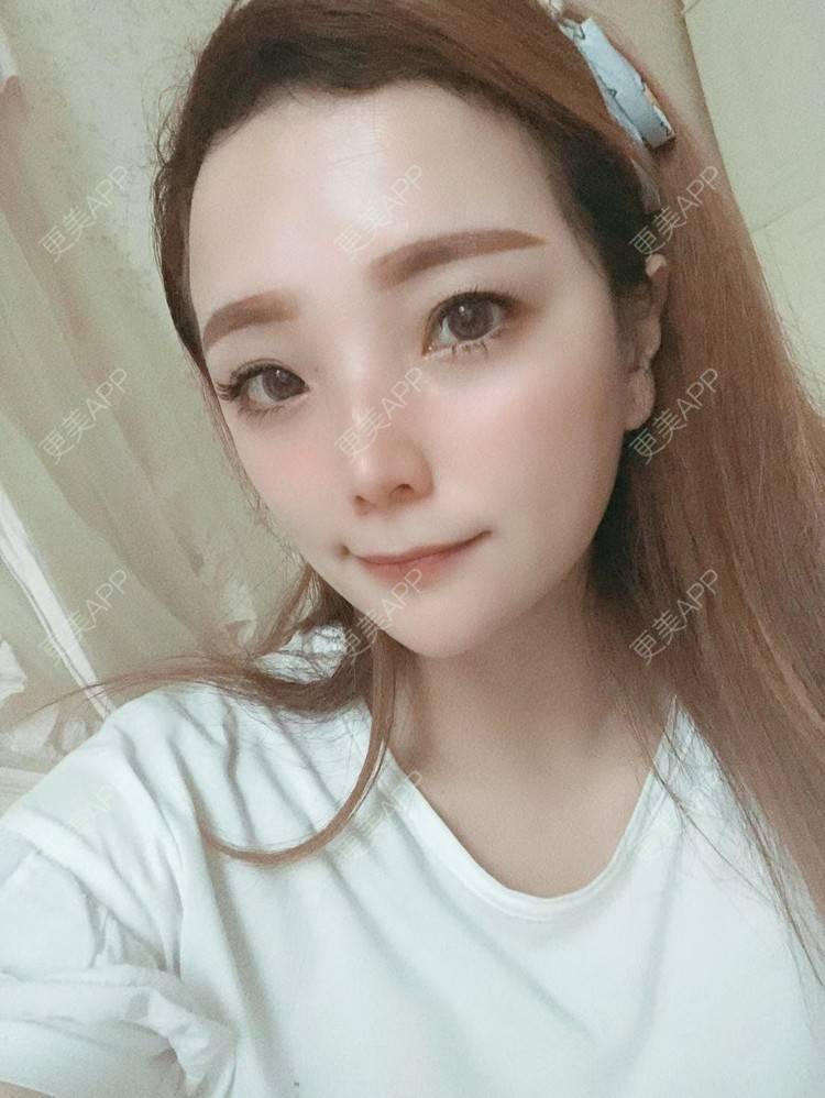 更美 - 更美用户EWqDuvHmIb的自体脂肪丰面颊经验 | 自体脂肪丰面颊 | 成都