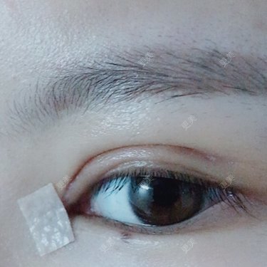 全切双眼皮
