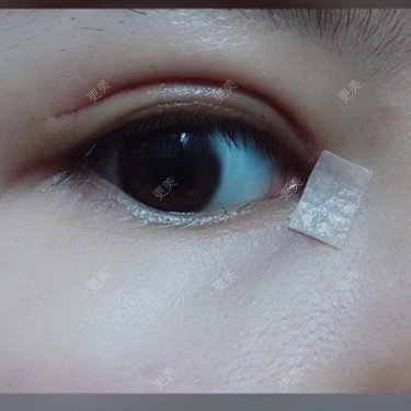 全切双眼皮