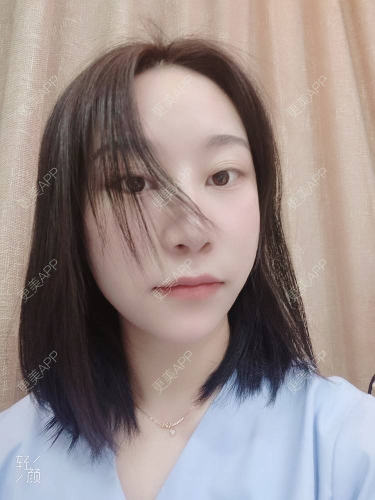 更美 - 更美用户QwczJNGlYL的鼻部多项经验 | 鼻部多项 | 鼻中隔软骨垫鼻头 | 自体软骨垫鼻尖 | 鼻小柱缩短 | 手术缩鼻头 | 鼻部综合