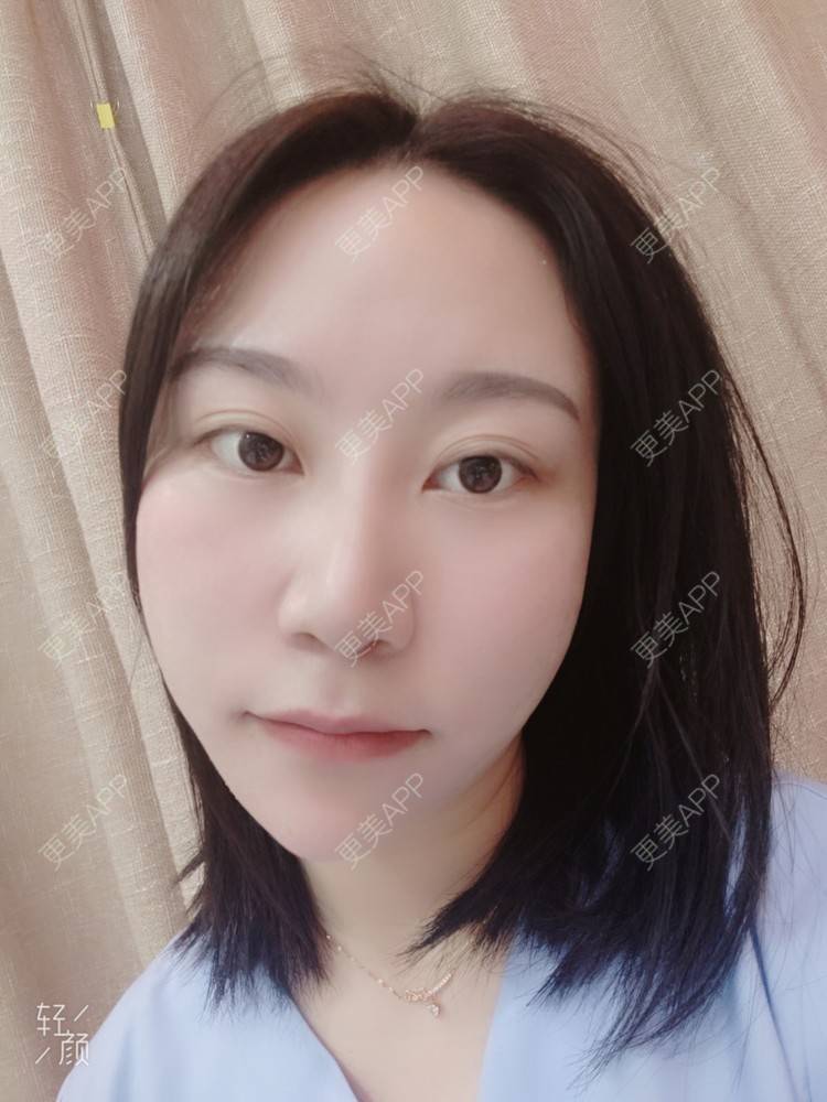 更美 - 更美用户QwczJNGlYL的鼻部多项经验 | 鼻部多项 | 鼻中隔软骨垫鼻头 | 自体软骨垫鼻尖 | 鼻小柱缩短 | 手术缩鼻头 | 鼻部综合