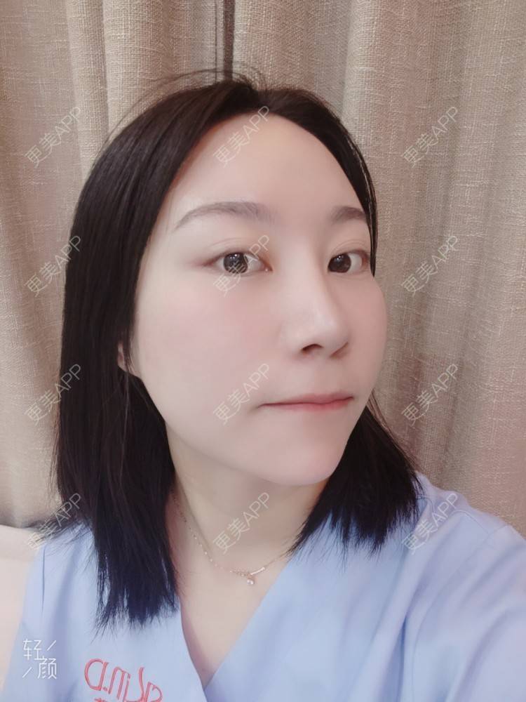 更美 - 更美用户QwczJNGlYL的鼻部多项经验 | 鼻部多项 | 鼻中隔软骨垫鼻头 | 自体软骨垫鼻尖 | 鼻小柱缩短 | 手术缩鼻头 | 鼻部综合