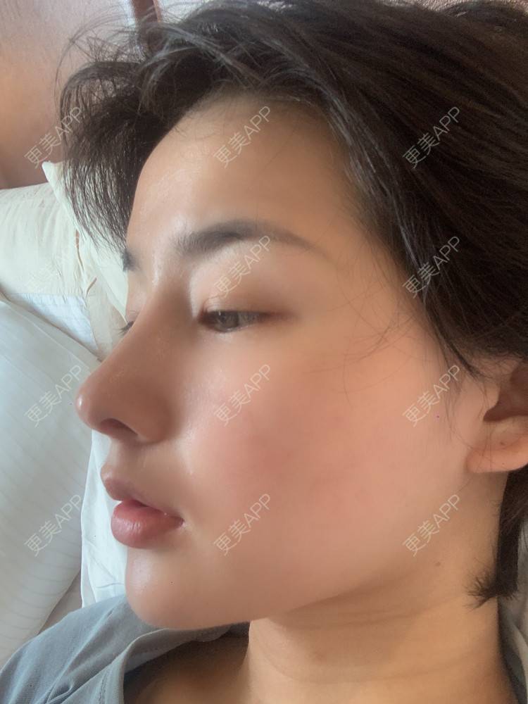 更美 - 更美用户cA33i6DxJX的鼻部多项经验 | 上饶 | 鼻部多项