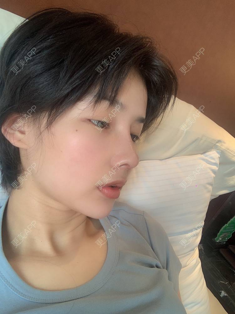 更美 - 更美用户cA33i6DxJX的鼻部多项经验 | 上饶 | 鼻部多项