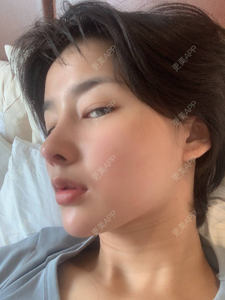 更美 - 更美用户cA33i6DxJX的鼻部多项经验 | 上饶 | 鼻部多项