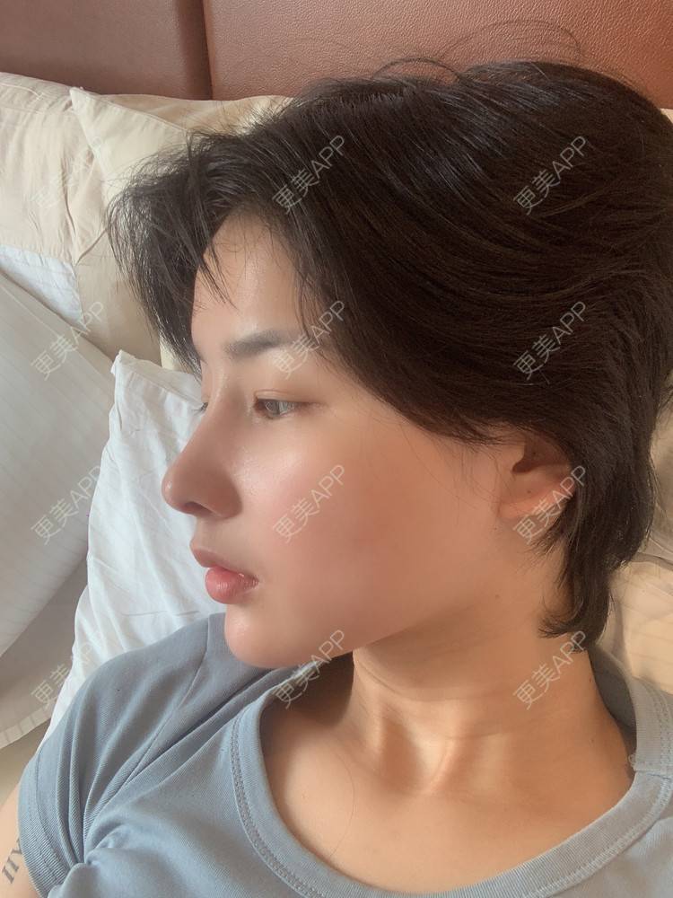 更美 - 更美用户cA33i6DxJX的鼻部多项经验 | 上饶 | 鼻部多项
