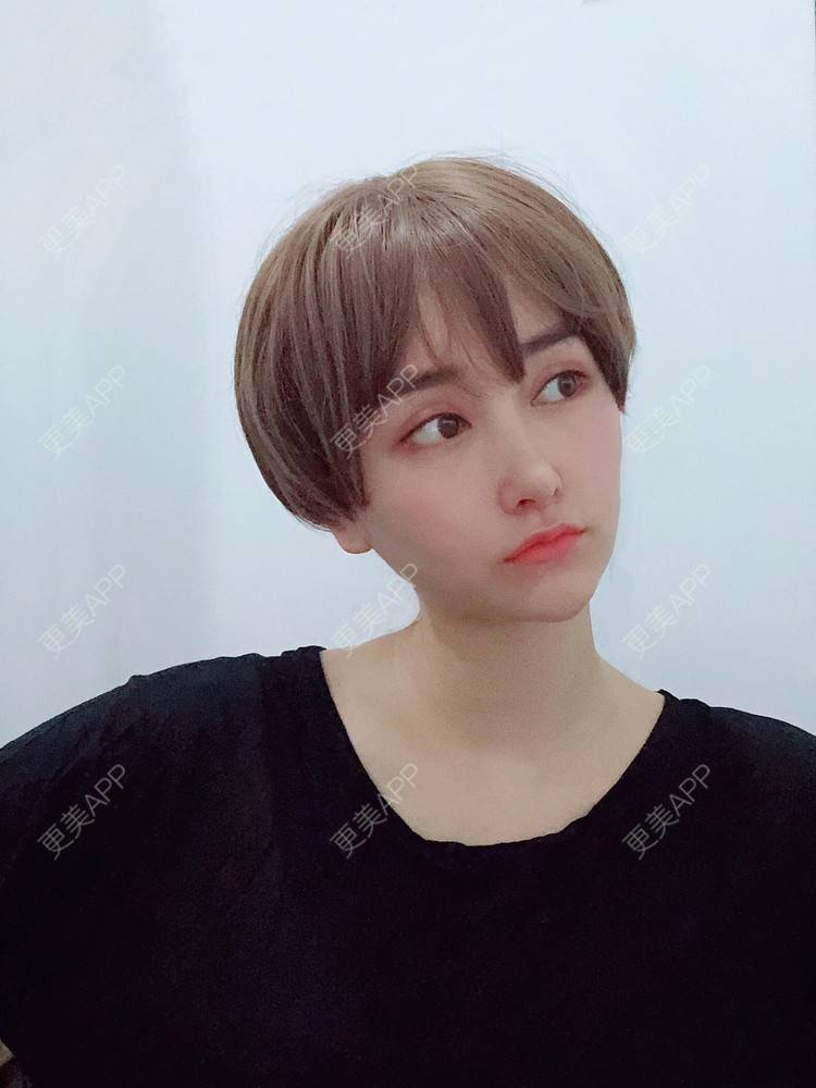 更美 - 是丽丽人儿呀的双眼皮修复经验 | 双眼皮修复 | 开眼角修复