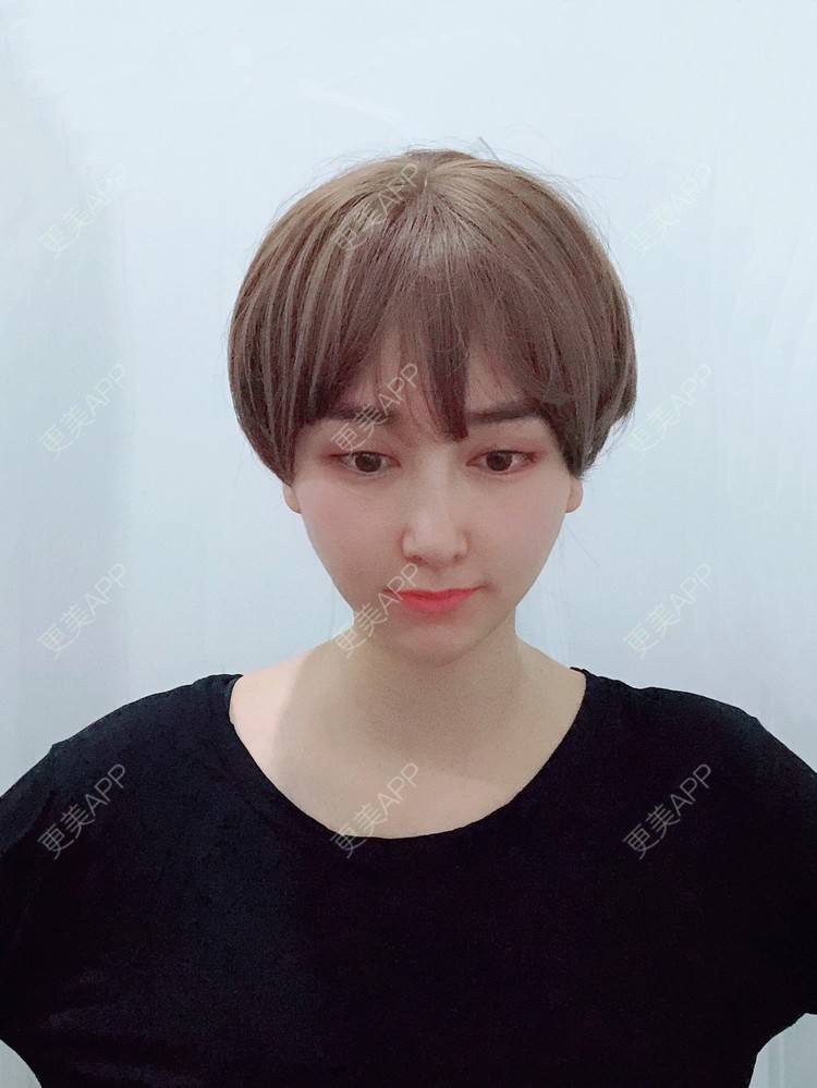 更美 - 是丽丽人儿呀的双眼皮修复经验 | 双眼皮修复 | 开眼角修复