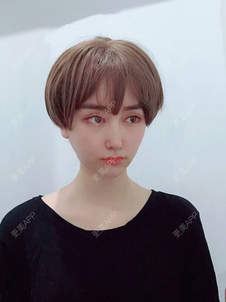 更美 - 是丽丽人儿呀的双眼皮修复经验 | 双眼皮修复 | 开眼角修复