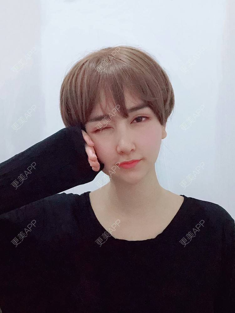 更美 - 是丽丽人儿呀的双眼皮修复经验 | 双眼皮修复 | 开眼角修复